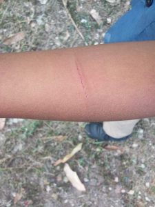 2015 - 3 year old boy with cuts from a belt